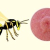 حشره زنبور زرد و آثار نیش آن
