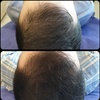 مزوتراپی مو(جلوگیری از ریزش مو،تقویت فولیکول مو،رشد مجدد موهای ریخته )